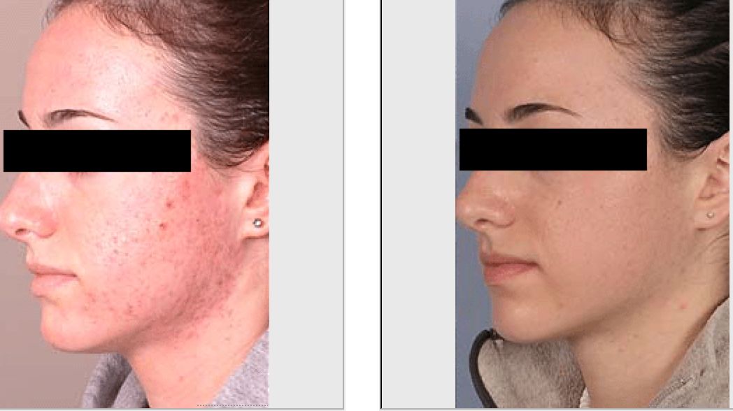 SilkPeel Before and After