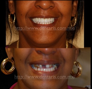 Before and Afer Dental treatments Dentaris