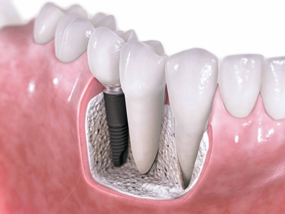 Dental Implant specialist
