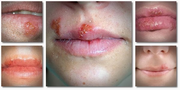 get rid of cold sores fast
