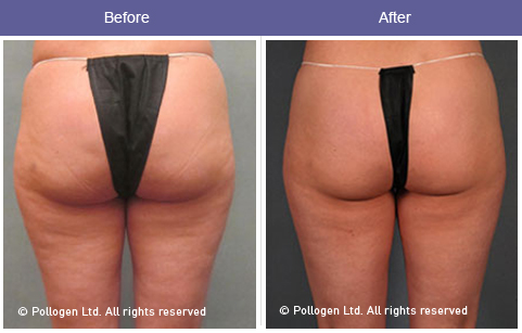 Cellulite reduction with TriPollar