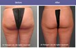 Cellulite reduction with TriPollar