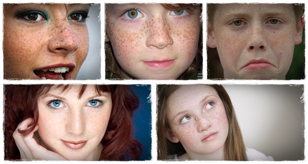 how to remove freckles