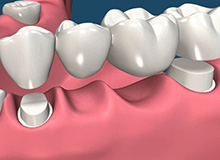 Dental Crowns and Bridges in North Miami, Aventura and Sunny Isles