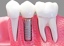 Dental Implants in North Miami, Aventura and Sunny Isles