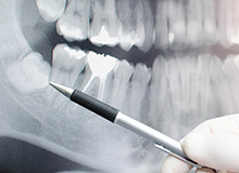 Wisdom Teeth Extractions at Biscayne Dental Center