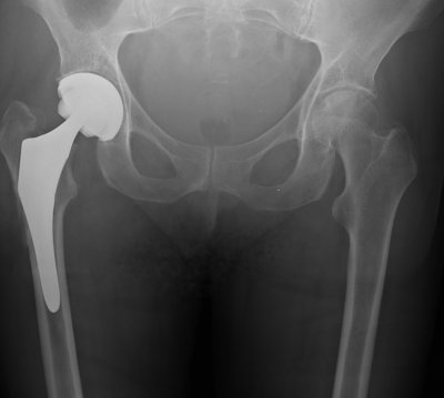 Asons Solicitors Comment on Metal Hip Replacement's High Failure Rates