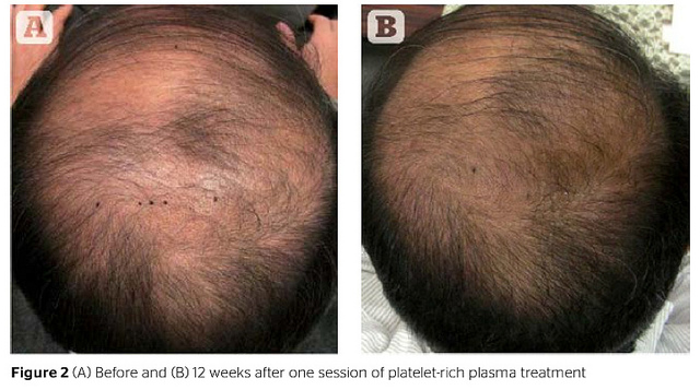 Male PRP patient - 12 weeks before-and-after