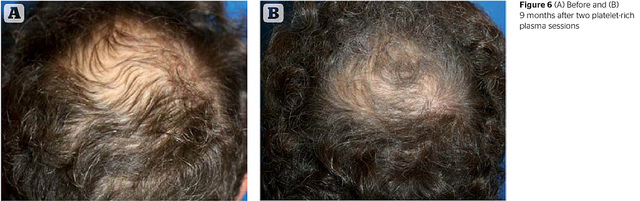 Male PRP patient - 9 months before-and-after