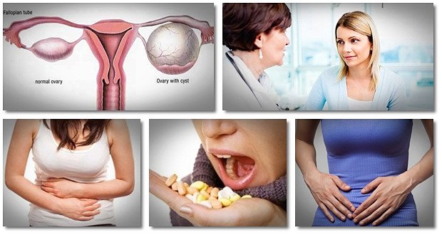 natural remedies for ovarian cysts