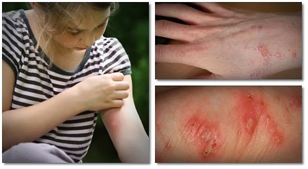 natural scabies treatment