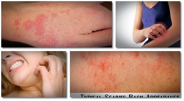 the scabies 24-hour natural remedy report