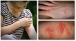 natural scabies treatment the scabies 24-hour natural remedy report can