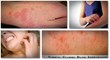 natural scabies treatment the scabies 24-hour natural remedy report help