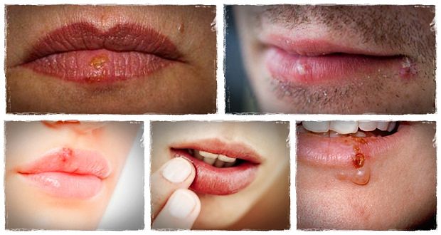 how to get rid of cold sores naturally