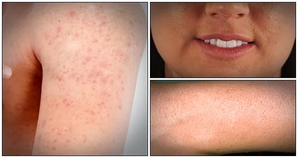 Discover Home Remedies For Keratosis Pilaris With The “banish My Bumps