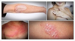 15 tips on severe psoriasis treatment