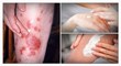 15 tips on severe psoriasis treatment can
