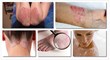 15 tips on severe psoriasis treatment help