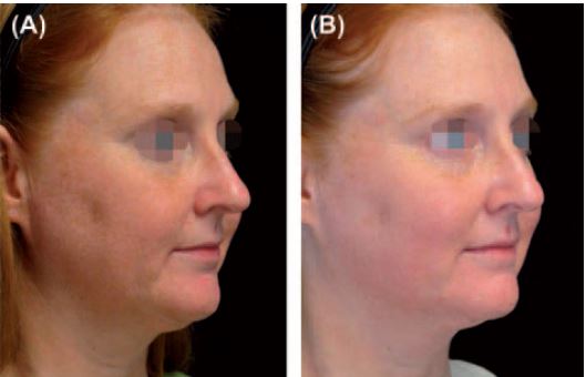 TriFractional Results - brightening and evening out of skin tone, epidermal renewal and enhanced skin appearance