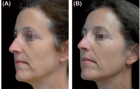 TriFractional results -  tighter firmer skin and a reduction in fine lines