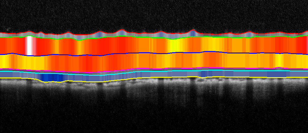 Scan of a rat retina, the false color-coding enhances visualization of the layer thicknesses