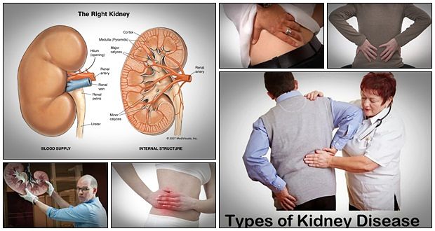 the kidney disease solution program
