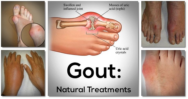 the gout remedy report pdf