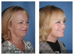 Before and After Surgery Photo of Facelift Patient Face and Neck Lift Natural Lift Board Certified Facial Plastic Surgery Orange County California