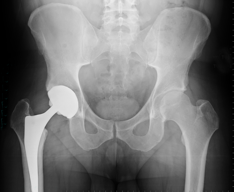 Hip Implant Xray