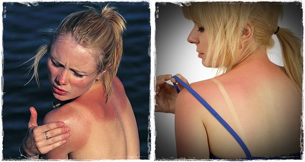 how to treat sunburn