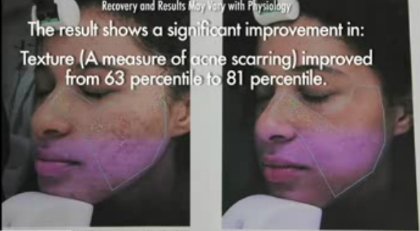 VISIA digital imaging analysis of acne treatment