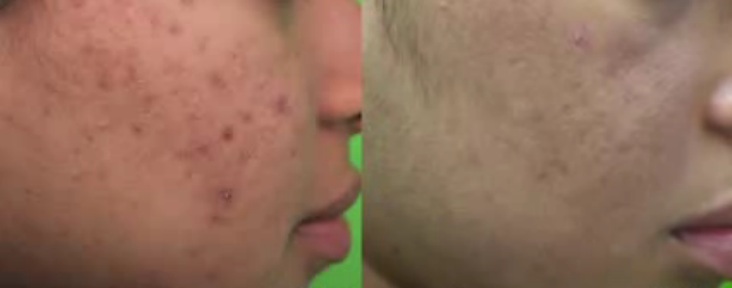 profile view of patient before and after acne and scar  treatment with laser
