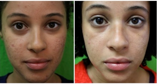 Los Angeles patient before and after acne treatment with laser
