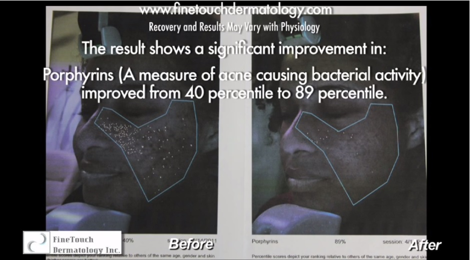 VISIA digital imaging analysis of porphyrins as a measure of acne improvement