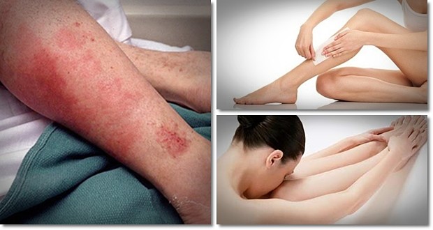 staph infection secrets review