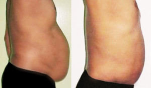 Lipo-Light: Male belly fat - Before and After