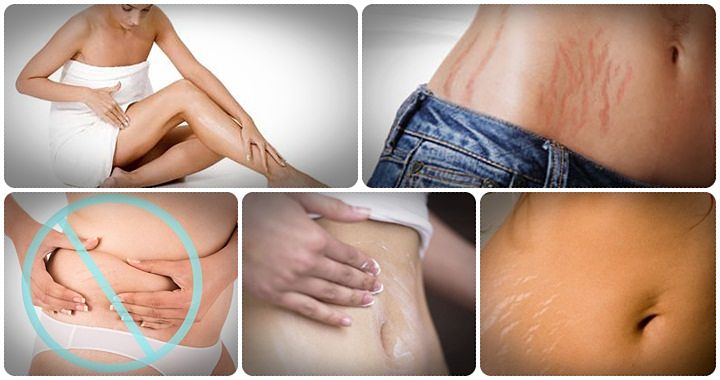 how to get rid of ugly stretch marks review