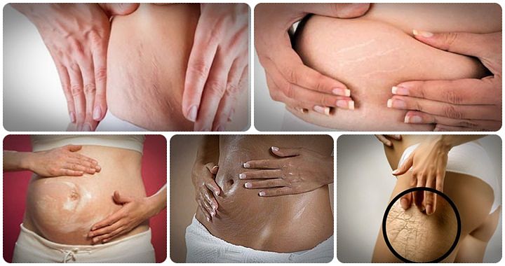 how to get rid of ugly stretch marks review