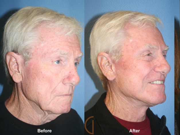 Before & After Male Facelift