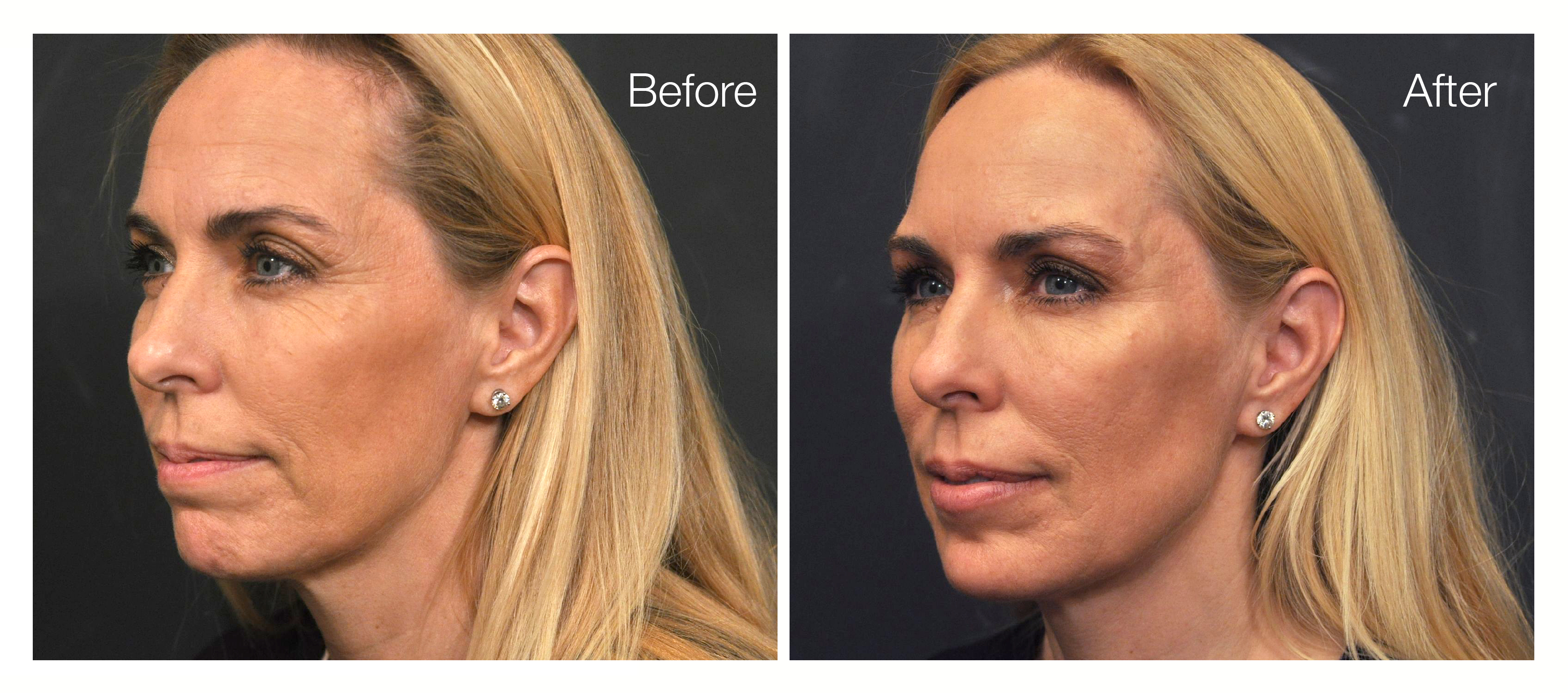 Juvèderm Voluma™ XC Before and After Photo