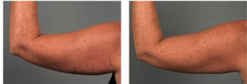 The CoolFit attachment can target upper arm fat and remove it non-invasively