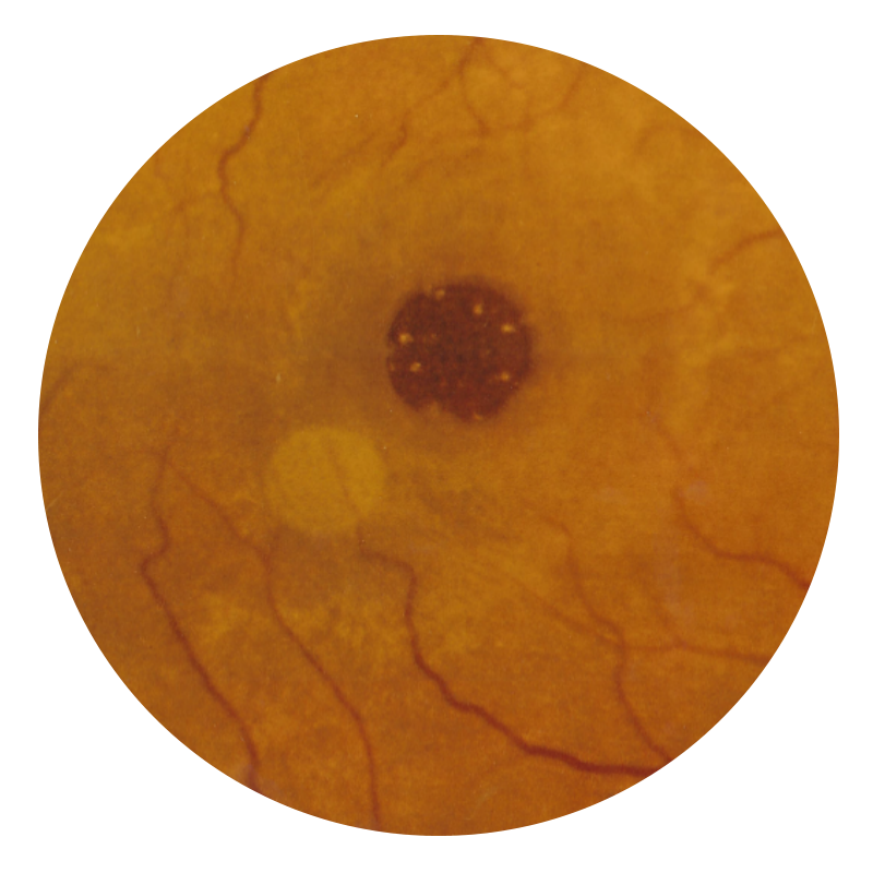 Retina with Dry Macular Degeneration