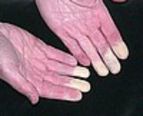 This is what the fingers of one with Raynauds Syndrome look like most of the day.