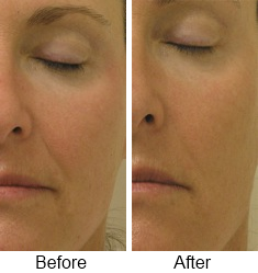 Before and after a HydraFacial skin resurfacing treatment. The Beauty Spot in Boulder, CO, now offers HydraFacials.