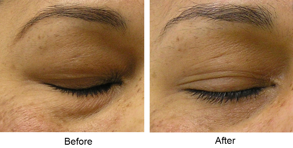 A client's eye puffiness before and after a HydraFacial skin resurfacing treatment. The Beauty Spot in Boulder, CO, now offers HydraFacials.