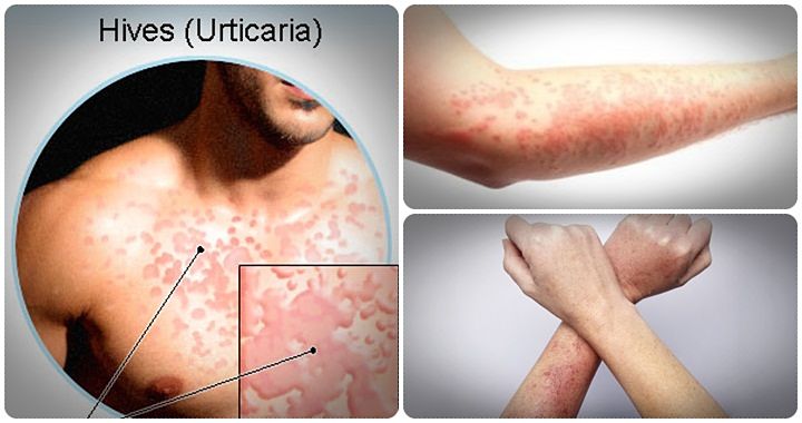 the urticaria solution review