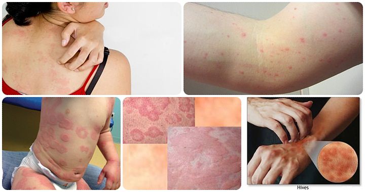 the urticaria solution review