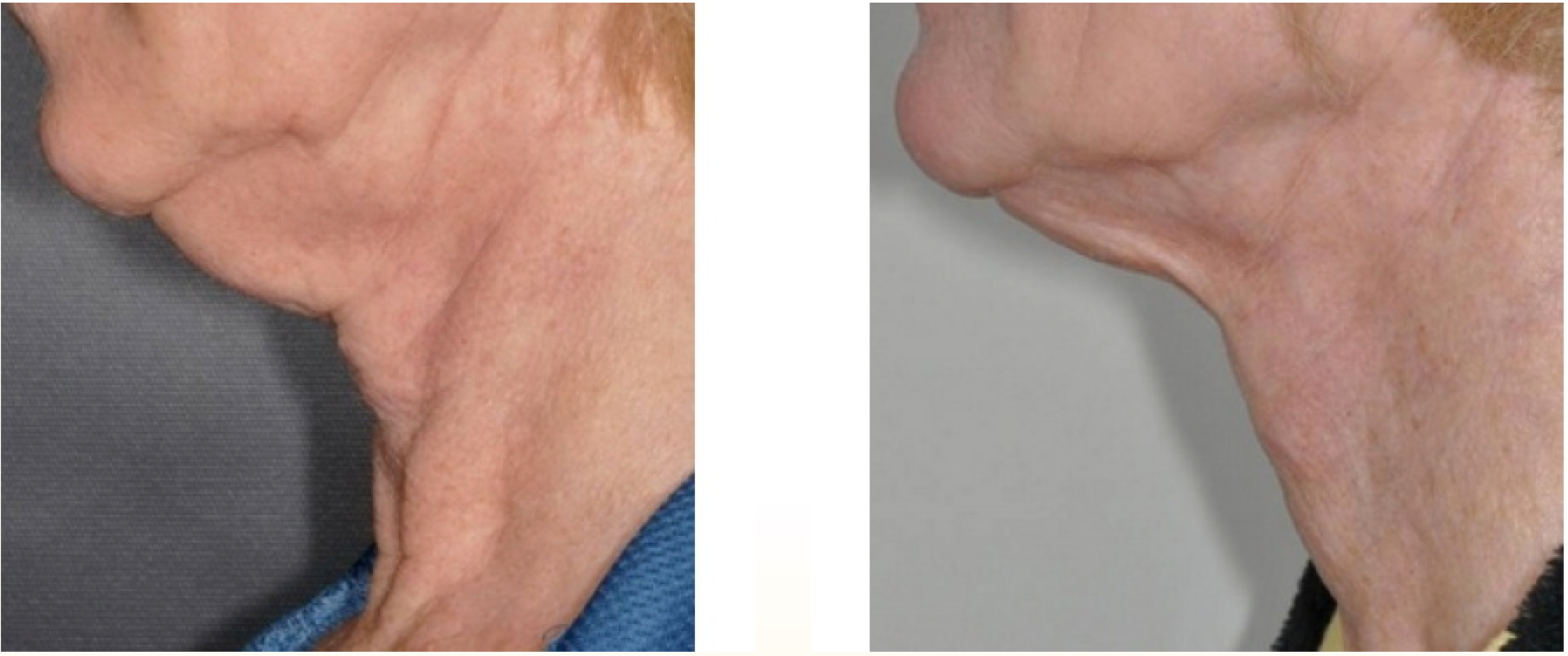 Exilis Neck fat 4 treatments