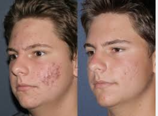 Fraxel Restore® diminishes acne scarring.